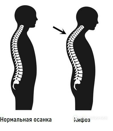 В основе кифоза лежит ослабление мышц спины
